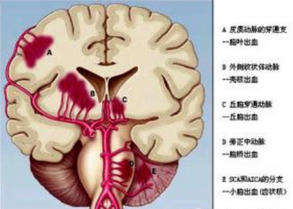 腦室出血的新管理應(yīng)用模式